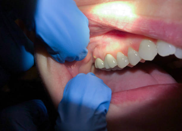 Best Root Canal Emergency Dentist  in Bargaintown, NJ